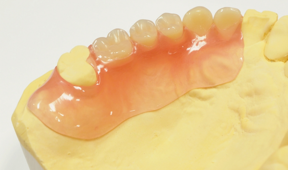 ノンクラスプデンチャー（自由診療）